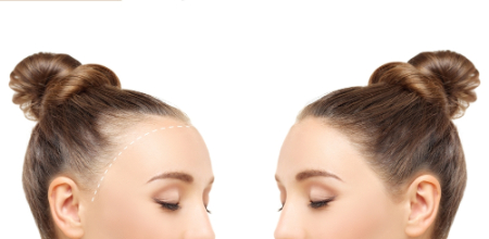 تأثیر هورمون‌ها بر ریزش مو