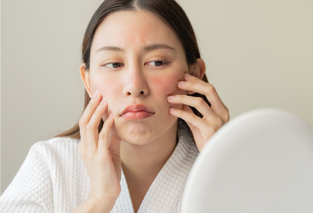 جوش هورمونی