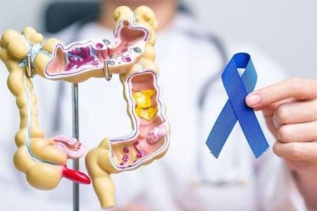 سرطان روده بزرگ،اخبار پزشکی،خبرهای پزشکی