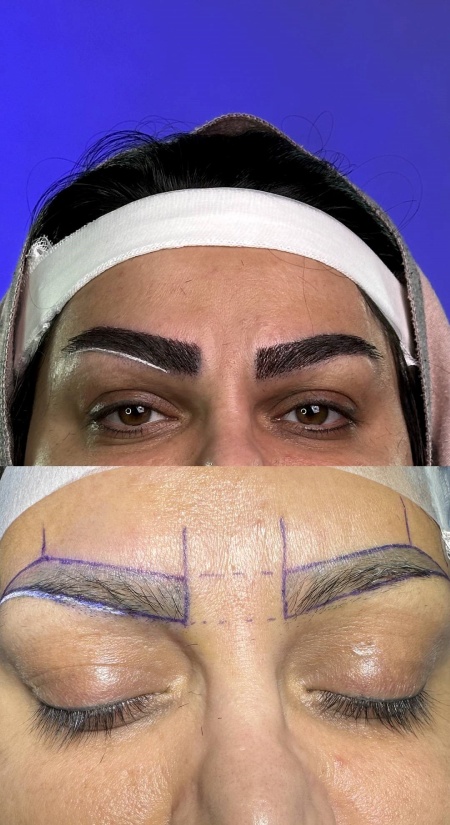 کاشت ابرو چیست؟ کاشت ابرو چیست؟