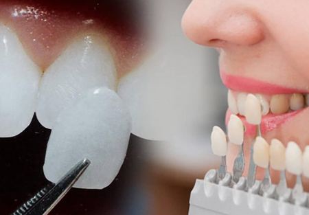 آیا کاندید مناسبی برای لمینت دندان هستید