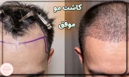 کاشت مو طبیعی