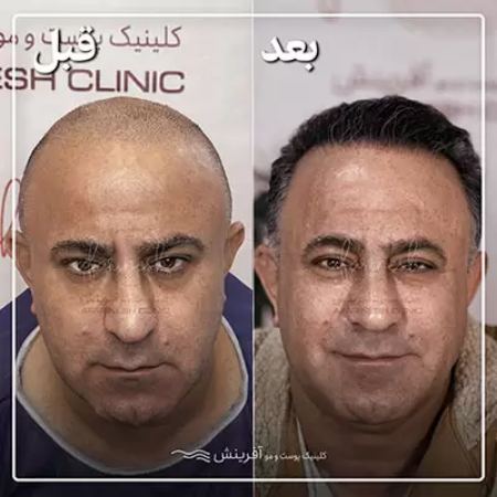 مهمترین نشانه های کاشت مو موفق