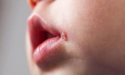 تفاوت آفت و تبخال در کودکان