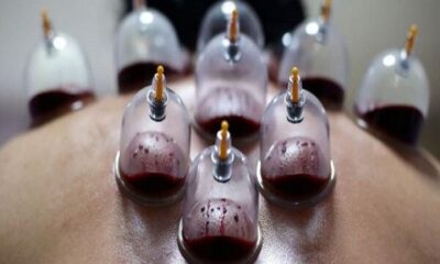 حجامت توسط افراد غیر متخصص خطرناک است
