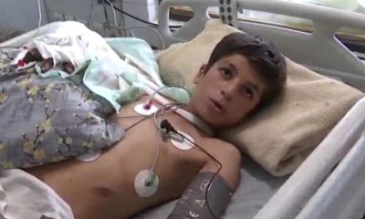 یک جراحی کم‌نظیر در بروجرد؛ دست قطع‌شده نوجوان دوباره به بدن بازگشت
